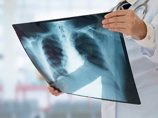 Роспотребнадзор предупреждает о росте заболеваемости пневмонией