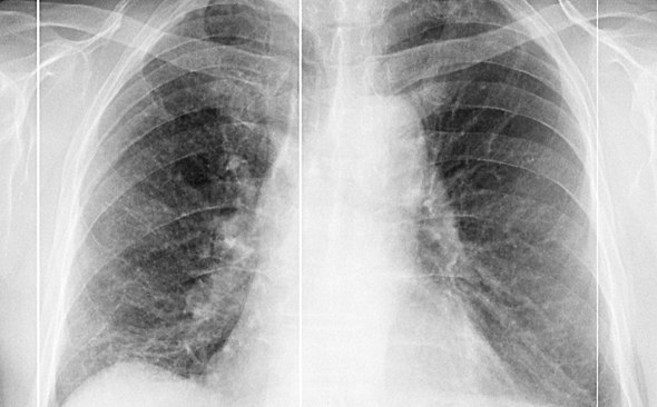Специалисты рассказали о необратимых последствиях COVID - 19