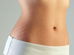 Все методы лечения растяжек