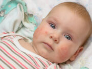 Атопический дерматит у детей. Как ухаживать за кожей ребенка при атопическом дерматите?