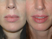 Bullhorn операция: показания, эффект, стоимость