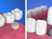 Зубной мост: плюсы и минусы