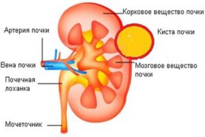 Киста почки: причины, симптомы, лечение