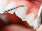 Пародонтит: причины, симптомы, лечение