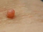 Кожный рог: лечение